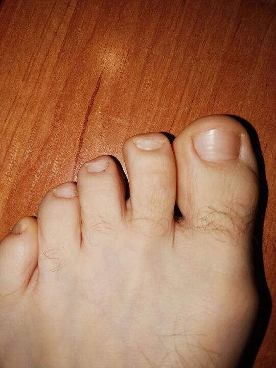 Pieds sans champignons après utilisation de la crème Exodermin